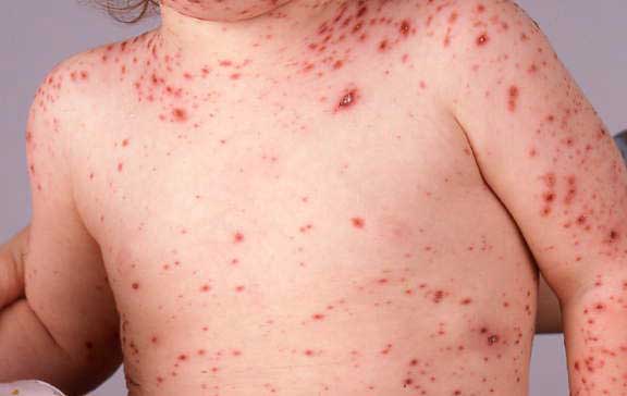 cómo aliviar la picazón de la varicela