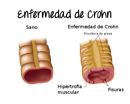 Qué es la enfermedad de Crohn