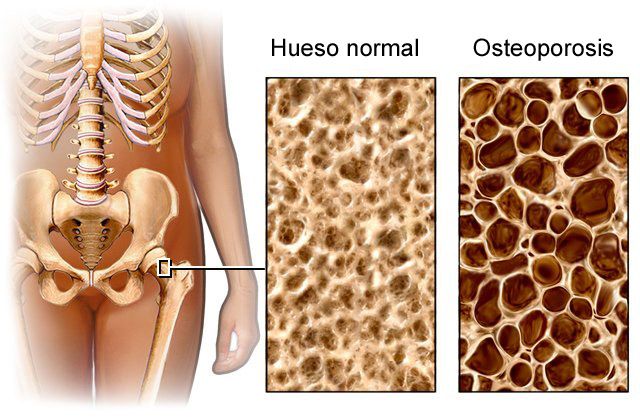 Cómo prevenir la osteoporosis y cuidar los huesos